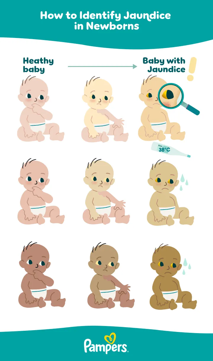 Illustration showing visual signs of jaundice in newborns across different skin tones to help identify a jaundice baby.