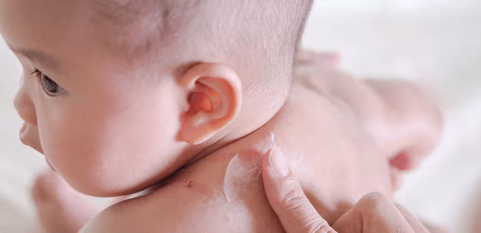 Bebé siendo tratado por picadura de mosquito.