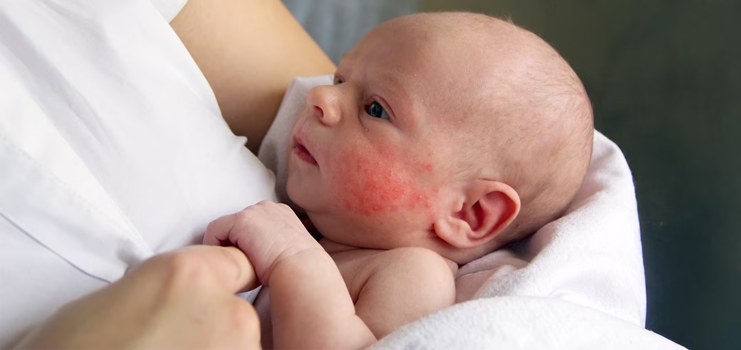  Baby suffering from eczema