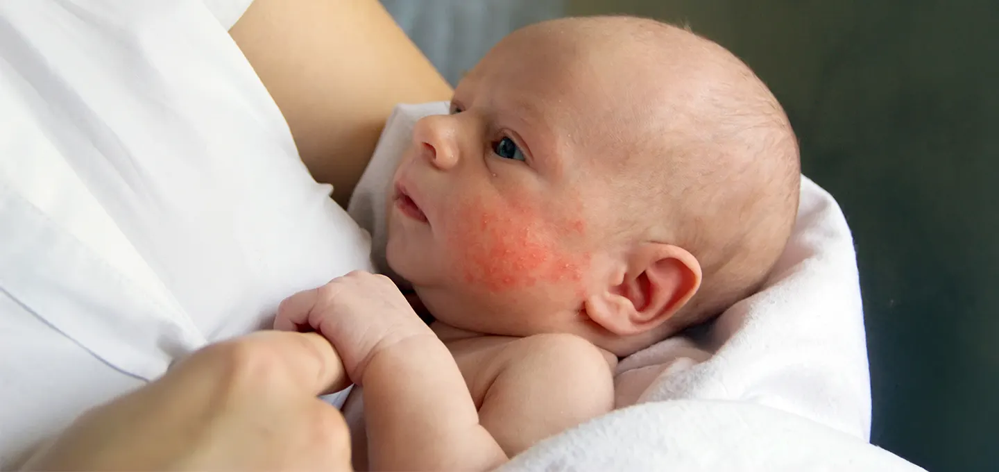 What to Do When Your Baby Has Eczema