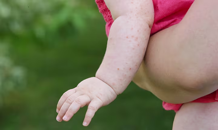 Baby heat rash