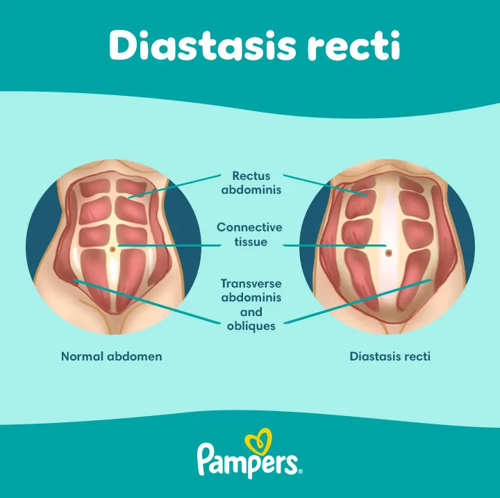 Diastasis recti Diastasis recti