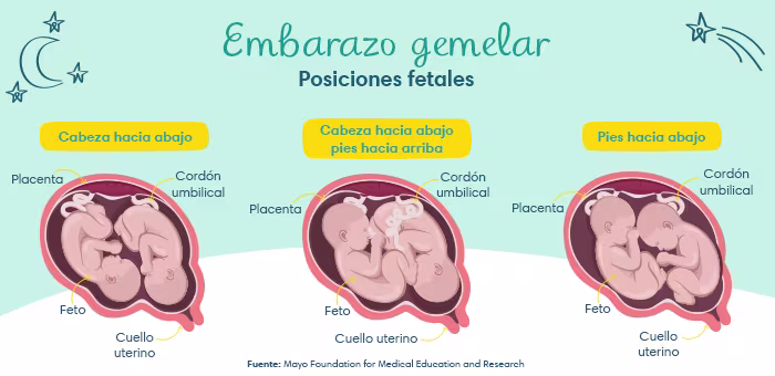 Embarazo gemelar: Posiciones fetales