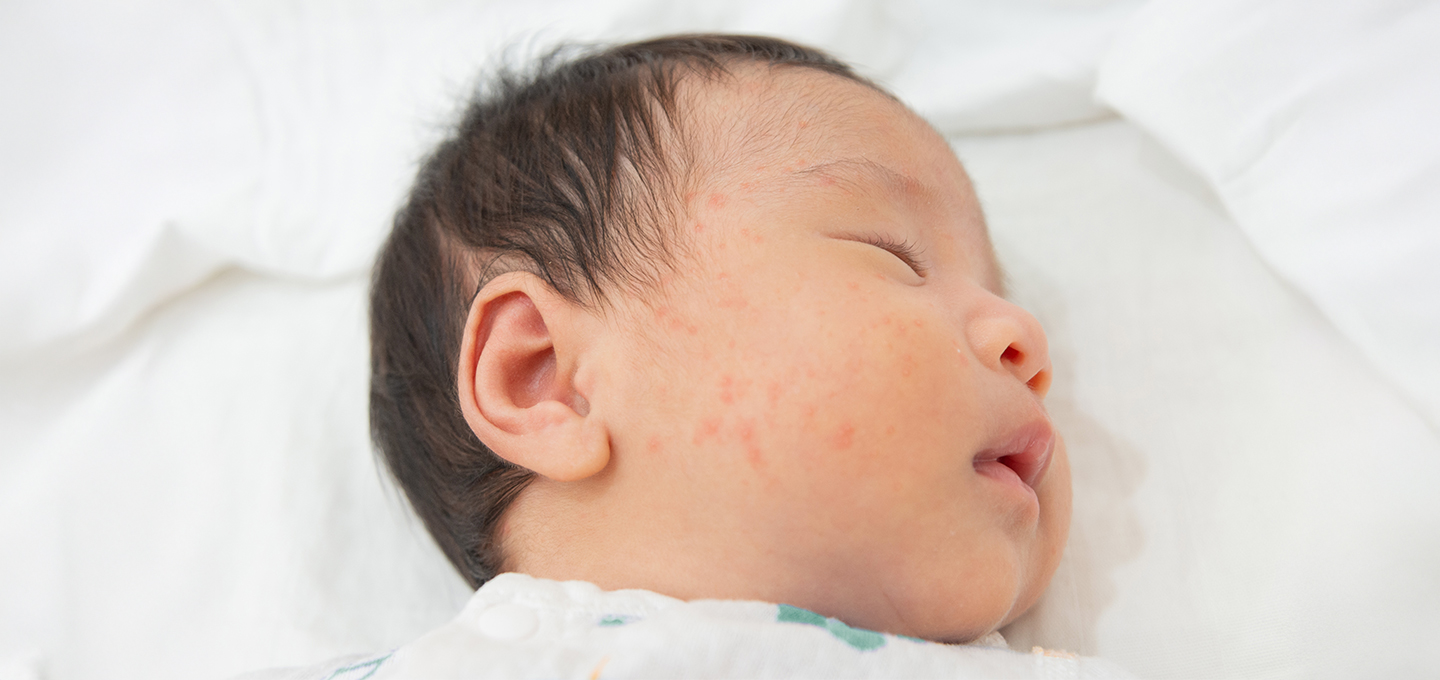 baby hives
