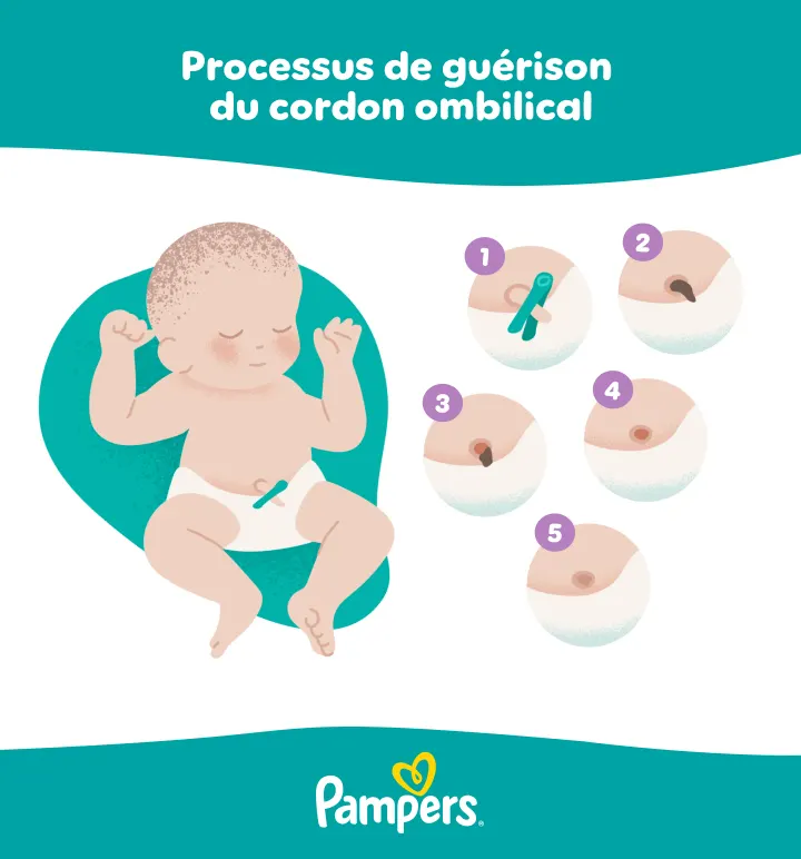Processus de cicatrisation du cordon ombilical