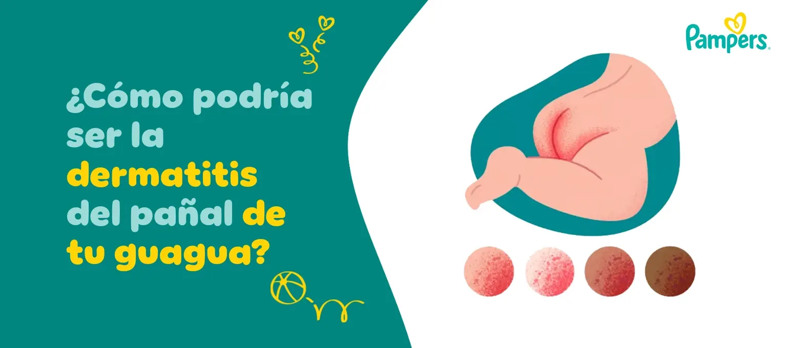 ¿Cómo podría ser la dermatitis del pañal de tu bebé?