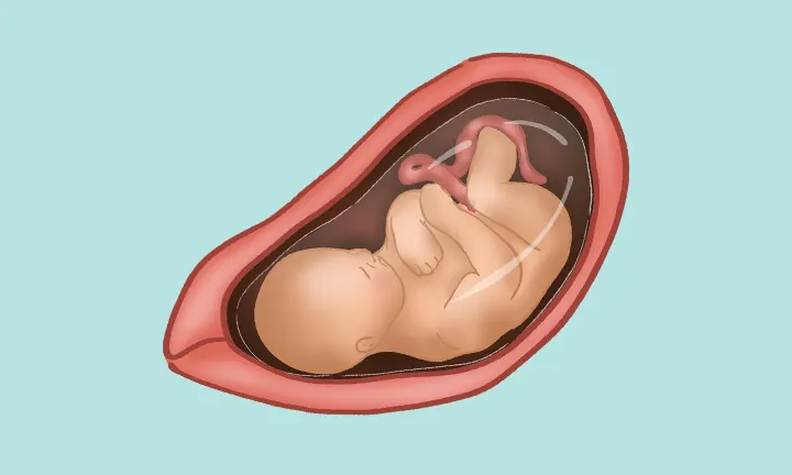 Lage des Babys in der 33. SSW Lage des Babys in der 33. SSW