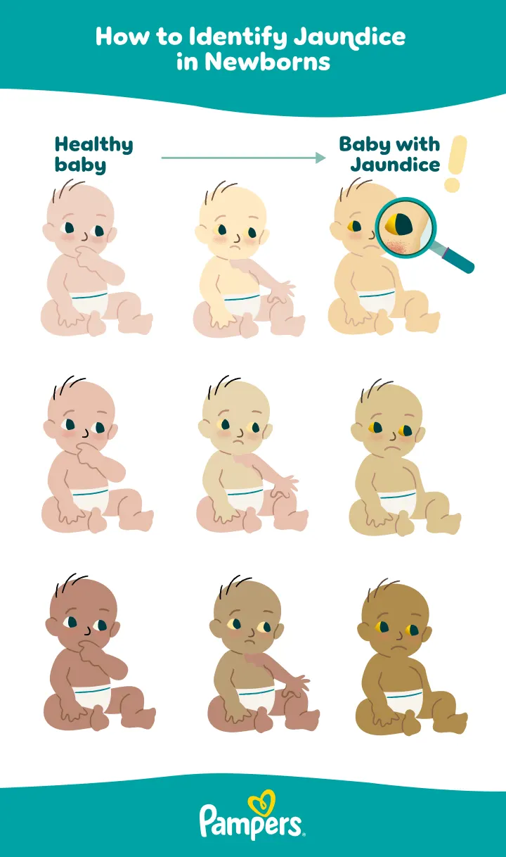 Infographic UK P Jaundice Newborns 720px