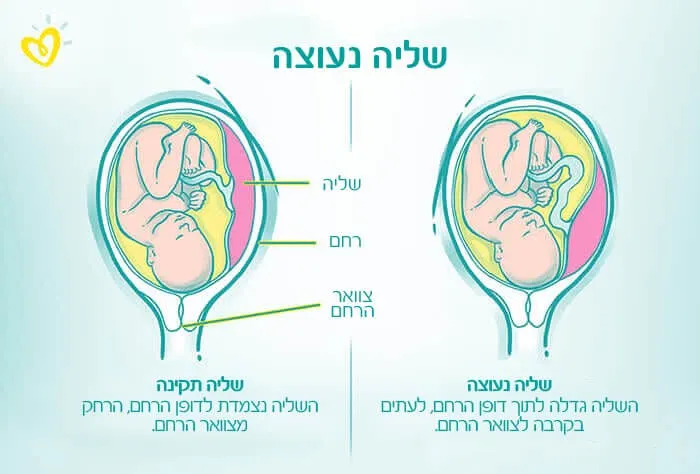 שליה נעוצה-Article Content Image infographic Placenta_Accreta_700X474