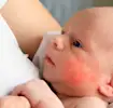 Wat moet je doen als je baby eczeem heeft?