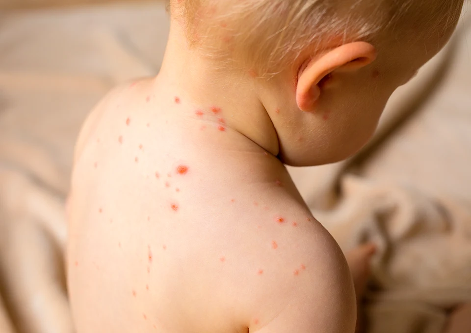 catapora em bebês