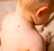 catapora em bebês