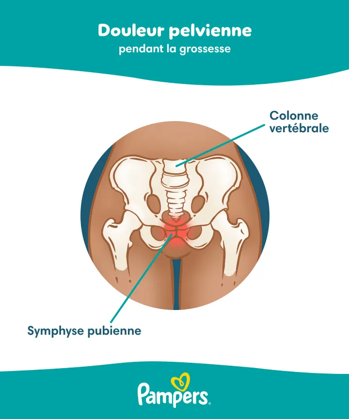 Illustration de la douleur pelvienne pendant la grossesse, mettant en évidence la colonne vertébrale et la symphyse pubienne.