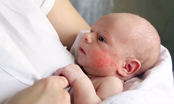 Bébé souffrant d’eczéma