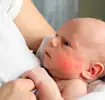 Eczema
