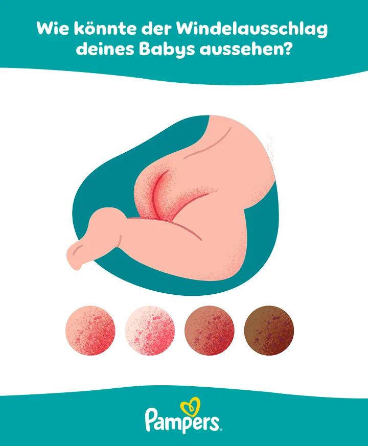 Windelausschlag (DE Baby rash) infographic - Desktop