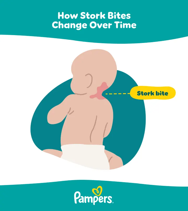 US P Stork bite 720px 20250226