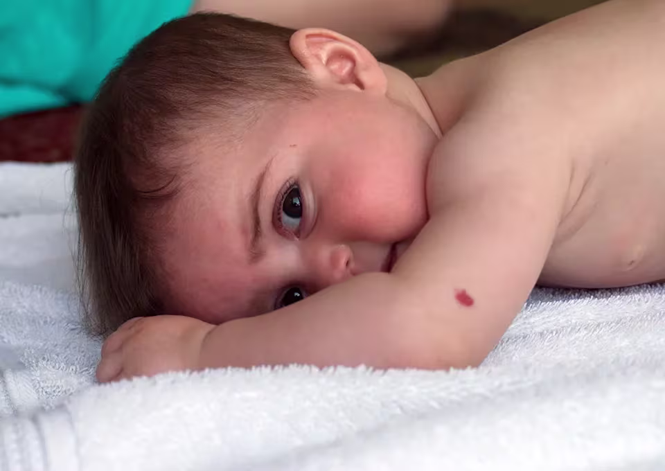 Baby-birthmark