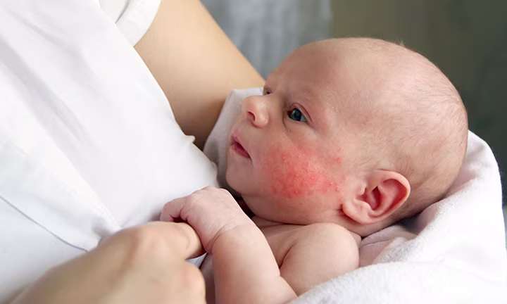 Baby rash