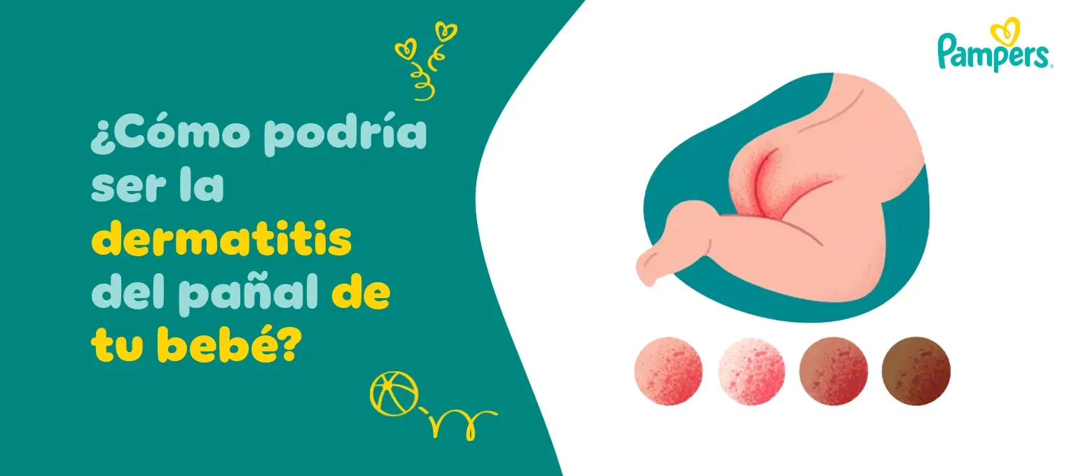 Así luce la dermatitis de tu bebé