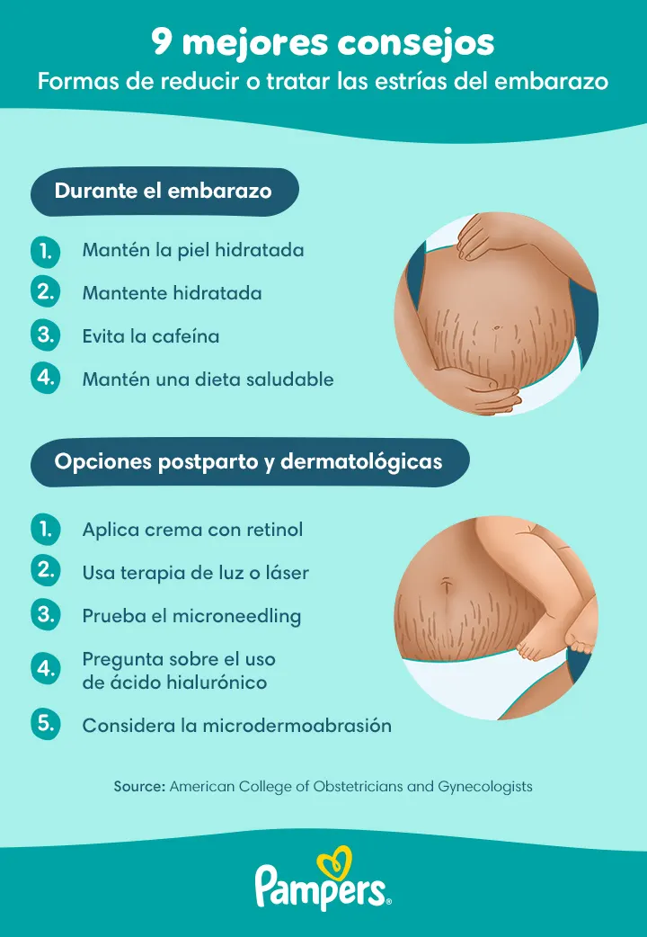 Infografía sobre estrías durante y después del embarazo Infografía sobre estrías durante y después del embarazo