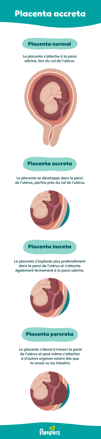 Pré-éclampsie : définition, symptômes, traitement