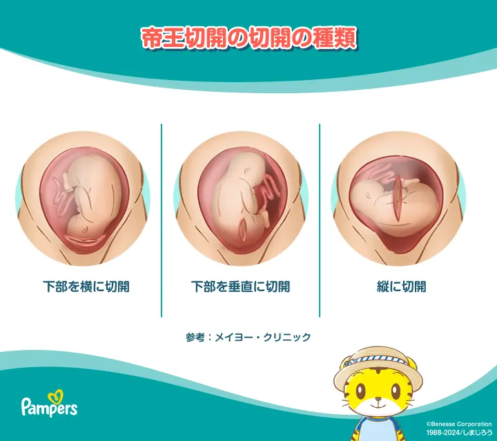 帝王切開の傷跡について