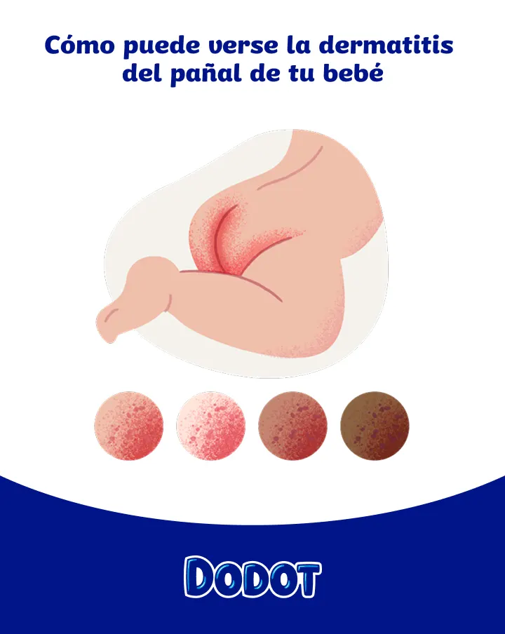 Dermatitis del pañal en la piel del bebé