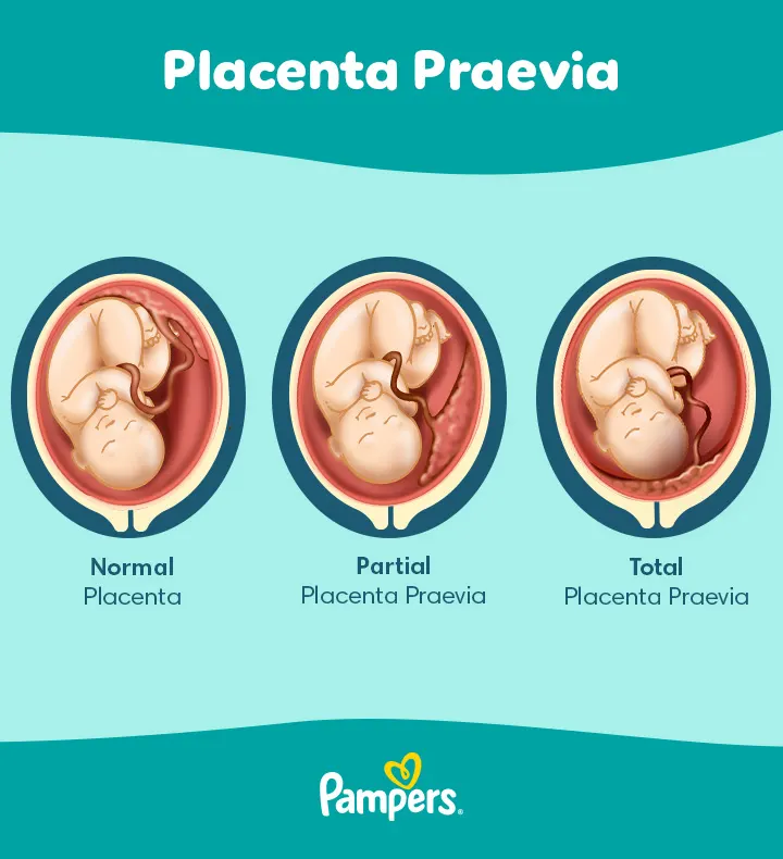 Types of Placenta Praevia 
