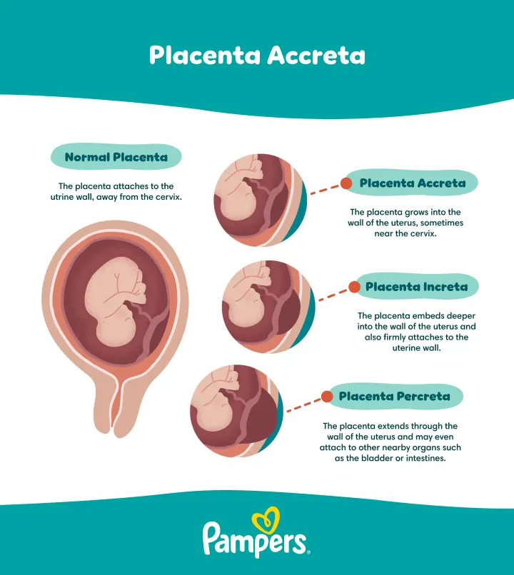 Placenta Accreta Spectrum
