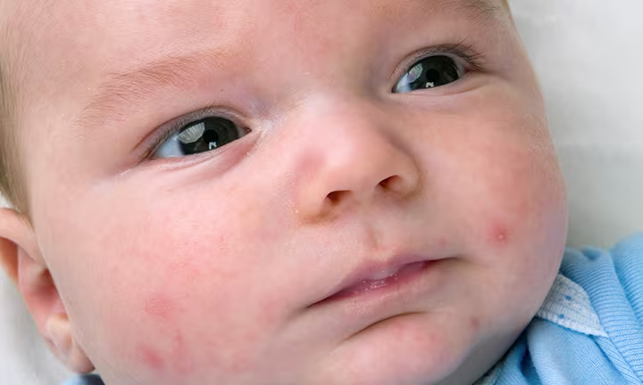 Close-up of a baby with sensitive skin wearing a blue outfit, looking to the side.