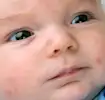 Close-up of a baby with sensitive skin wearing a blue outfit, looking to the side.