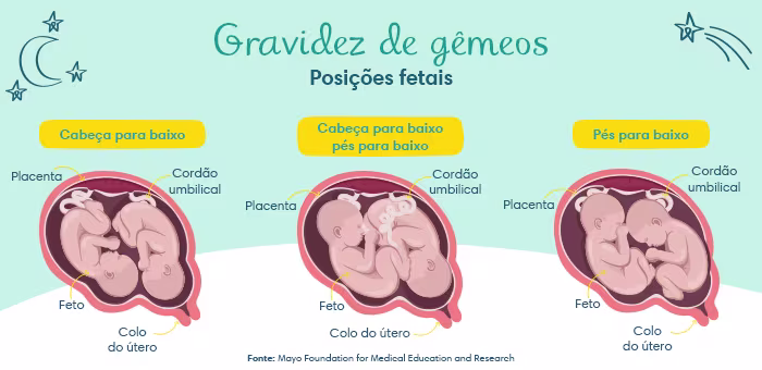 Gravidez de gêmeos - Posições fetais