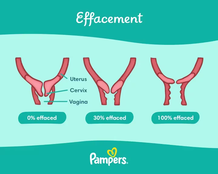 Effacement