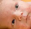 erupções cutâneas em bebês
