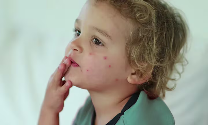 Bed bug Bites on Babies and Kids