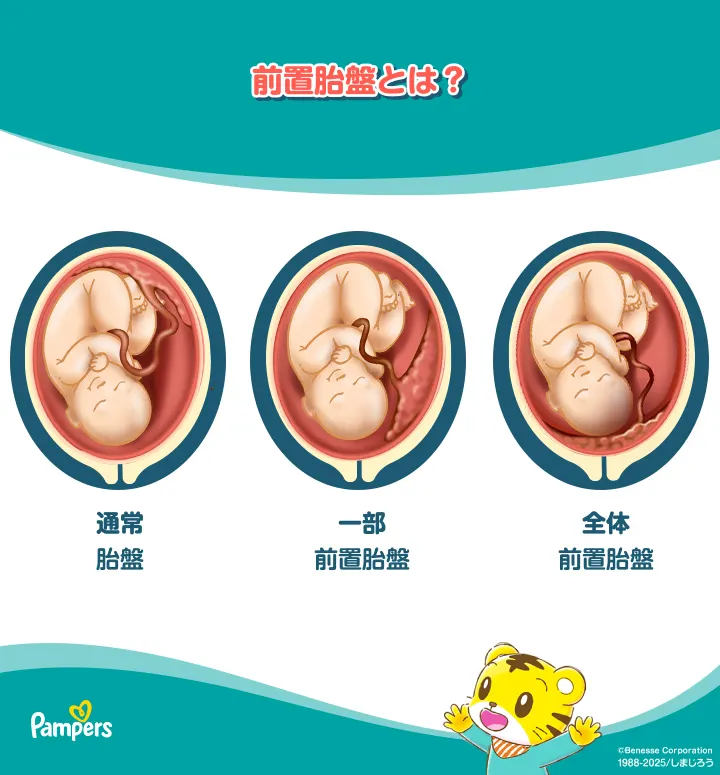 前置胎盤の種類 前置胎盤の種類