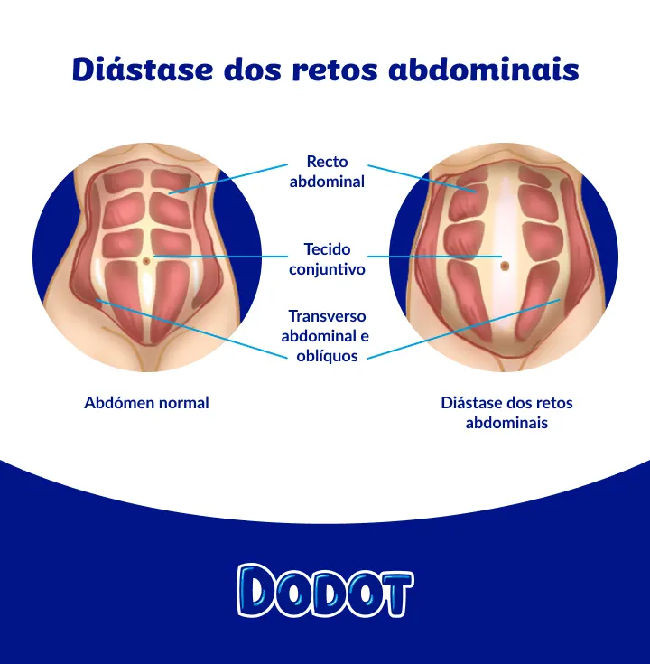 Diástase dos Retos Diástase dos Retos