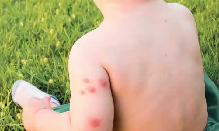 Mosquito Bites on Babies