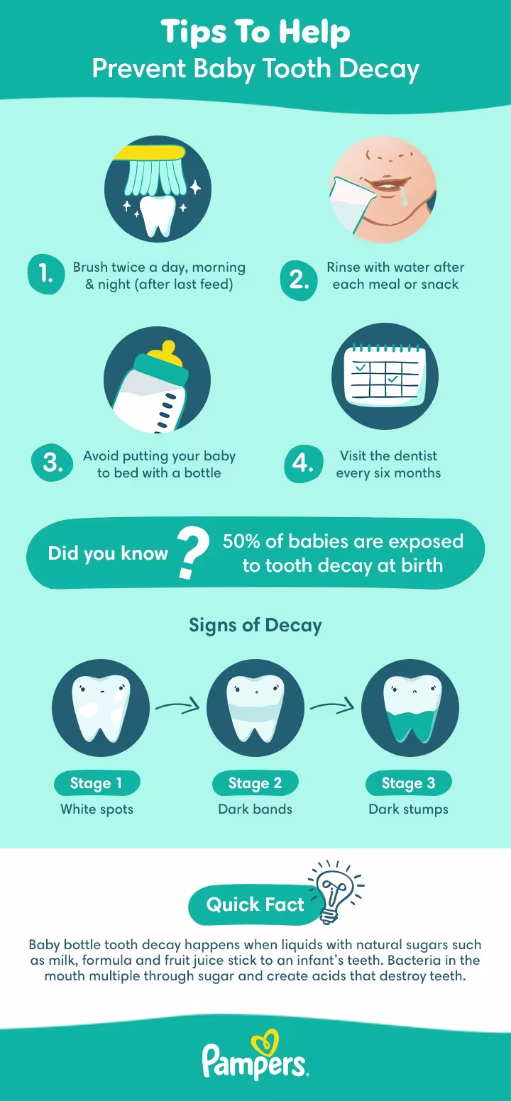 Tips to help prevent baby tooth decay