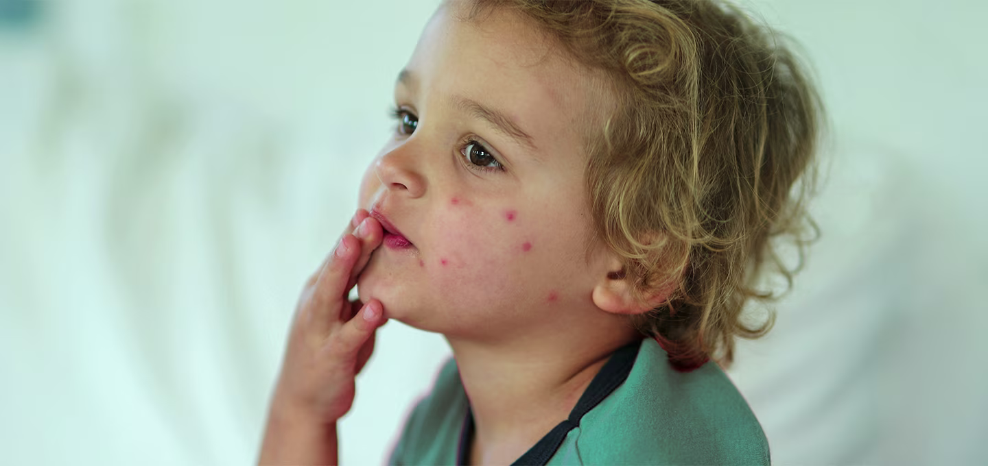 Bed bug Bites on Babies and Kids