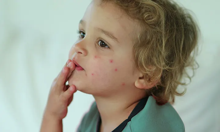 Bed bug Bites on Babies and Kids