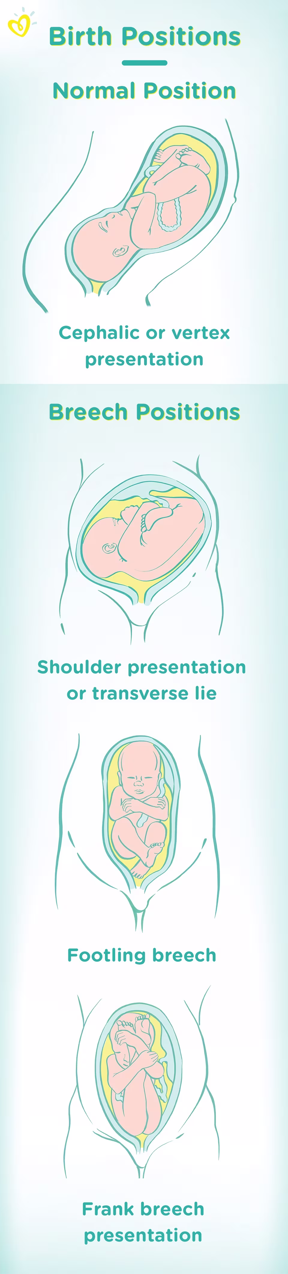 Breech presentation Breech presentation