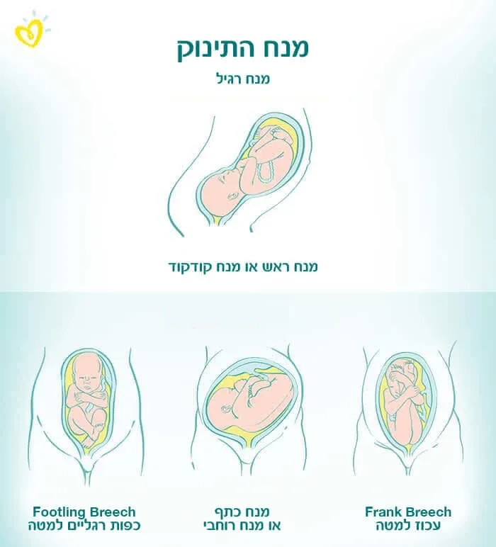 מצג עכוז-Article Content Image breech-presentation_700x340