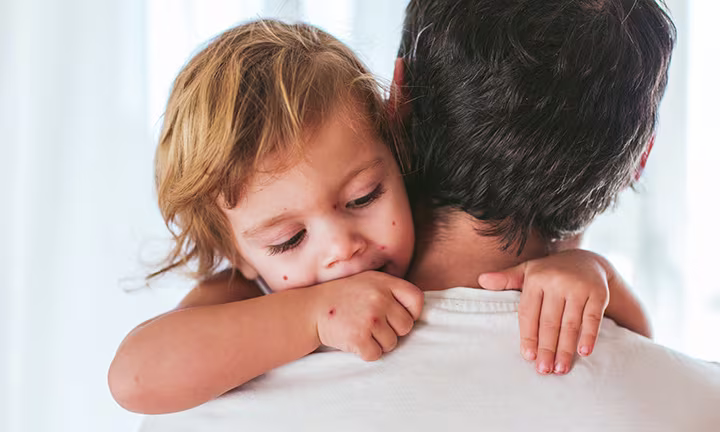 La varicelle chez les bébés
