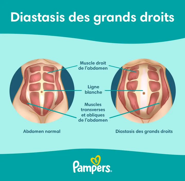 diastasis des grands droits pendant et apres la grossesse-Article Content Image FR Pampers Diastasis recti 20240325 720
