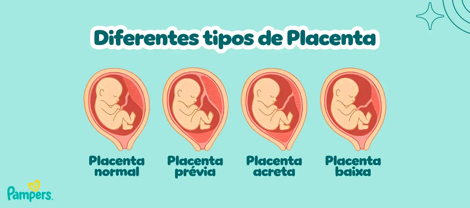 Diferentes tipos de Placenta Tipos de placenta