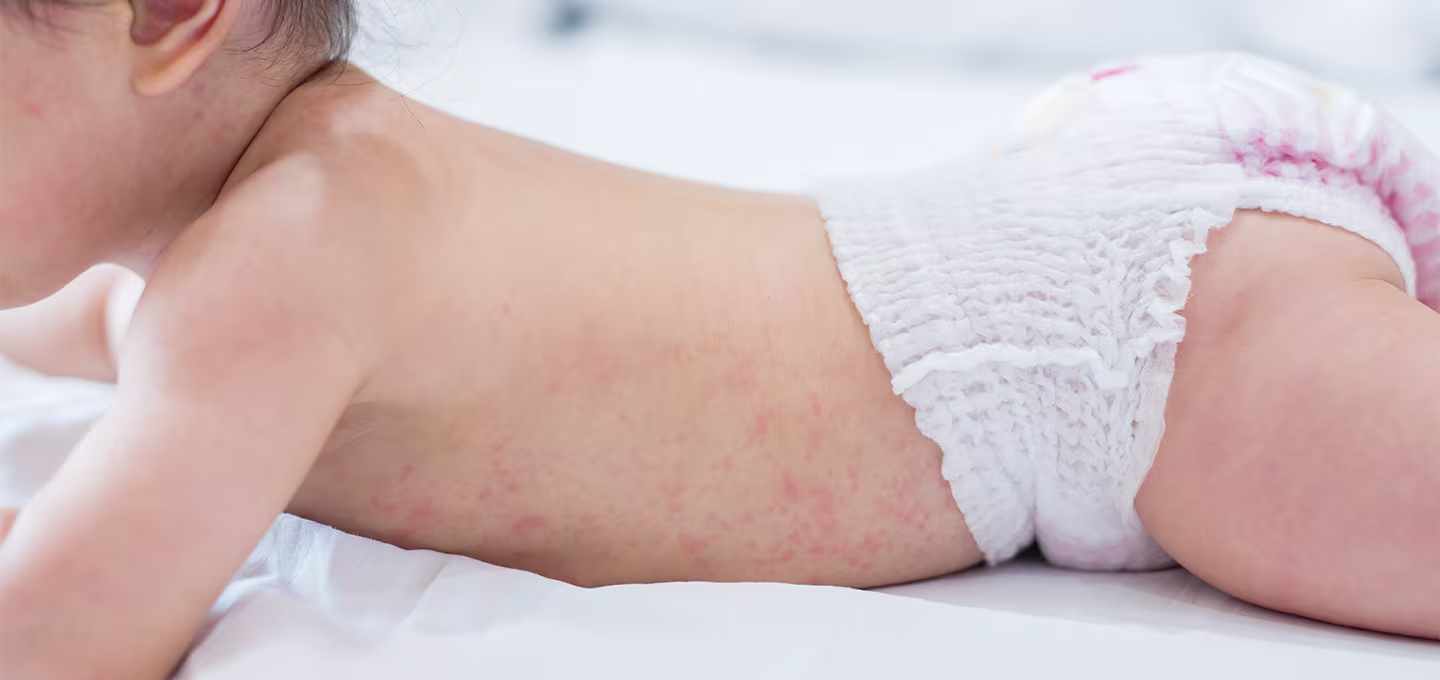 Bébé allongé sur le ventre portant une couche, avec une éruption cutanée rouge diffuse sur le dos et les flancs.