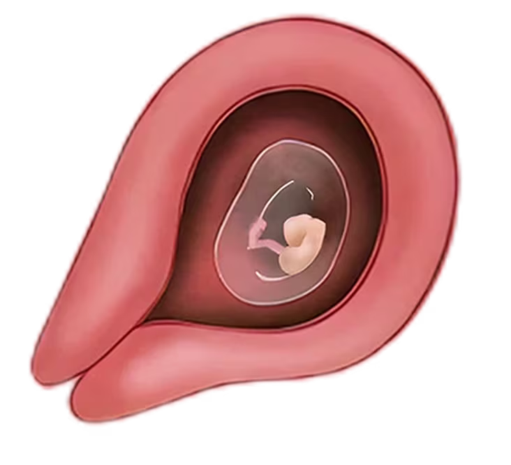 Illustration of a fetus at 1 month inside a womb, curled in the amniotic sac during early pregnancy. Illustration of a fetus at 1 month inside a womb, curled in the amniotic sac during early pregnancy.