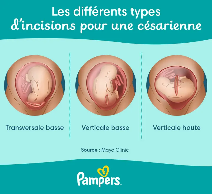 Les différents types d’incisions pour une césarienne
